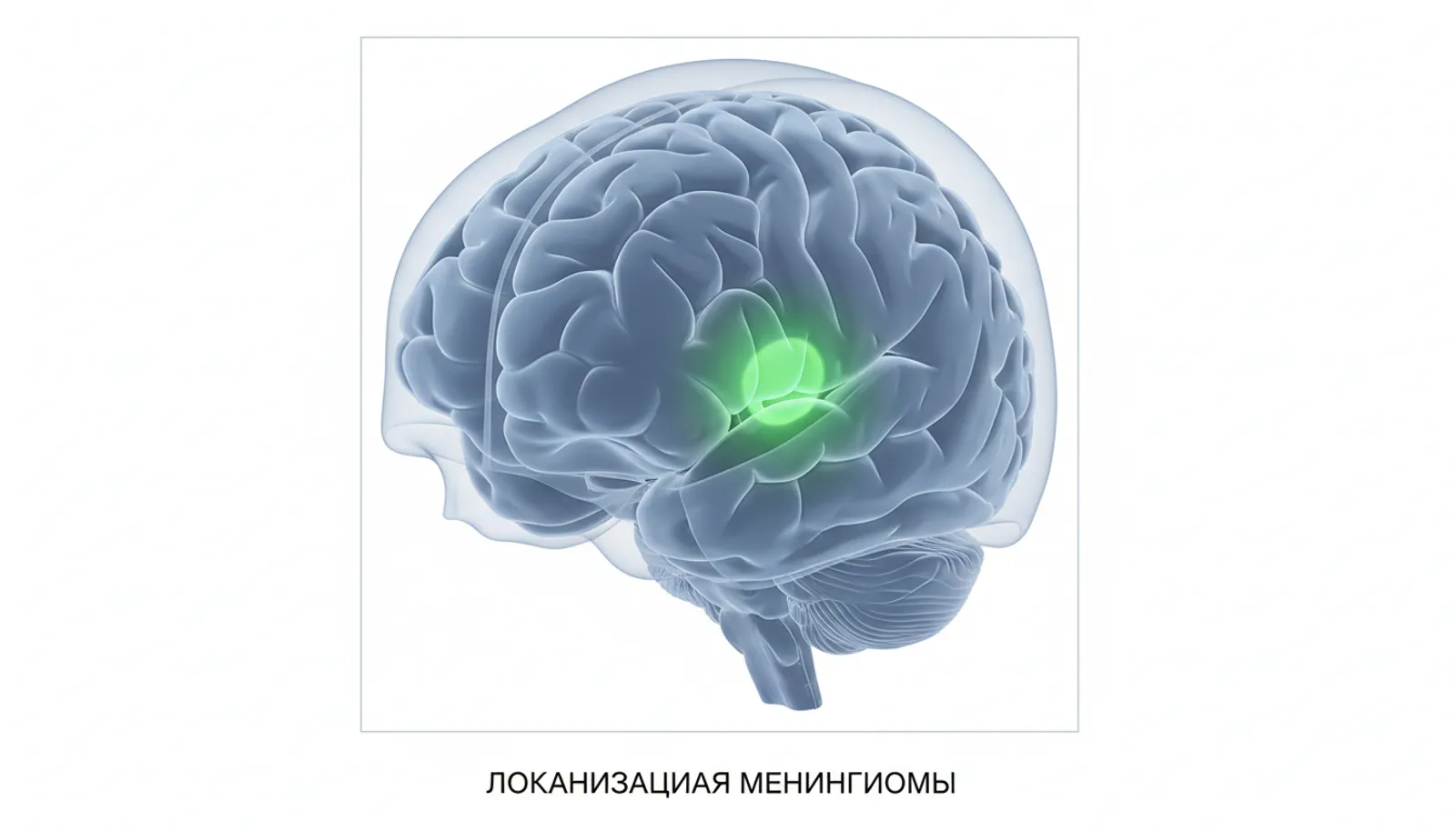 менингиома это онкология
